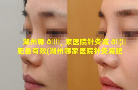 湖州哪 🕸 家医院针灸减 🦊 肥最有效(湖州哪家医院针灸减肥最有效果)